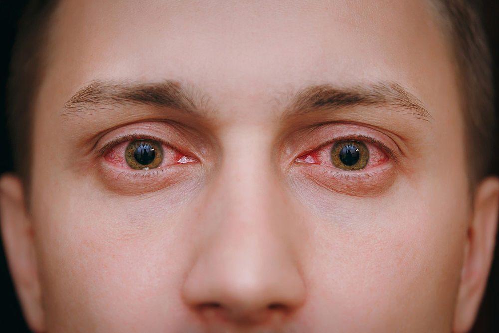 Ojo rojo sin dolor causas y cómo quitarlos